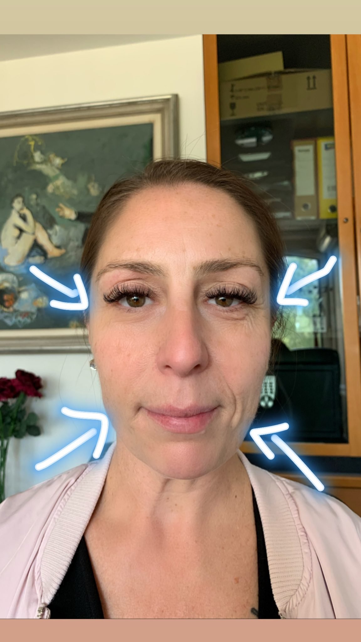 HIFU-PRIJE-I-POSLIJE-2