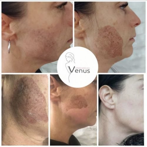 KEMIJSKI-PILING-3-600x630 (1)